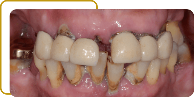 imagen de dentición terminal